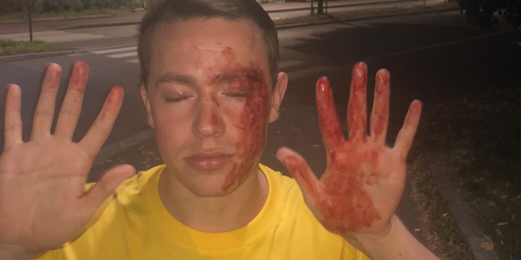 Slik såg OsloMet-studenten Edvin Eriksen ut etter å ha blitt regelrett skalla ned på nattbussen i Oslo natt til torsdag 13. august. 22-åringen måtte sy fire sting. Slik såg OsloMet-studenten Edvin Eriksen ut etter å ha blitt regelrett skalla ned på nattbussen i Oslo natt til torsdag 13. august. 22-åringen måtte sy fire sting.