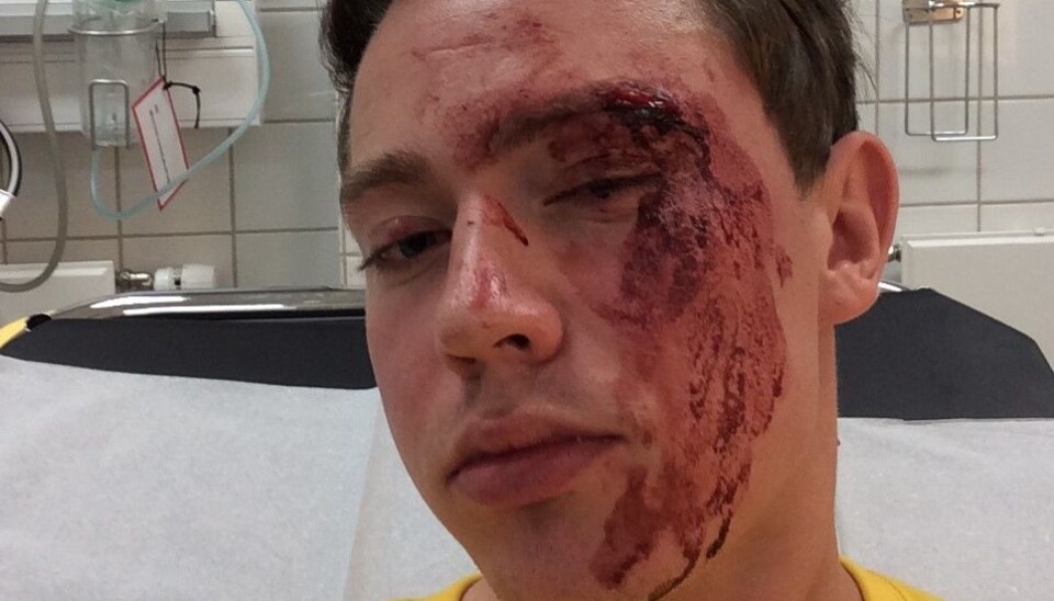 Slik såg Edvin Eriksen (22) ut etter hendinga i august. Dette bilete er privat og teken på legevakta i Oslo. Slik såg Edvin Eriksen (22) ut etter hendinga i august. Dette bilete er privat og teken på legevakta i Oslo.