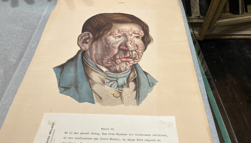 bildet viser tegning av en gutt med lepra, med det som ser ut som byller i ansiktet.